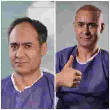 کاشت مو کرمان دکتررضاسعیدی در آبنوس کرمان