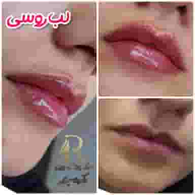 بوتاکس و فیلر(ژل لب) کرمان دکتر رضا سعیدی در آبنوس کرمان