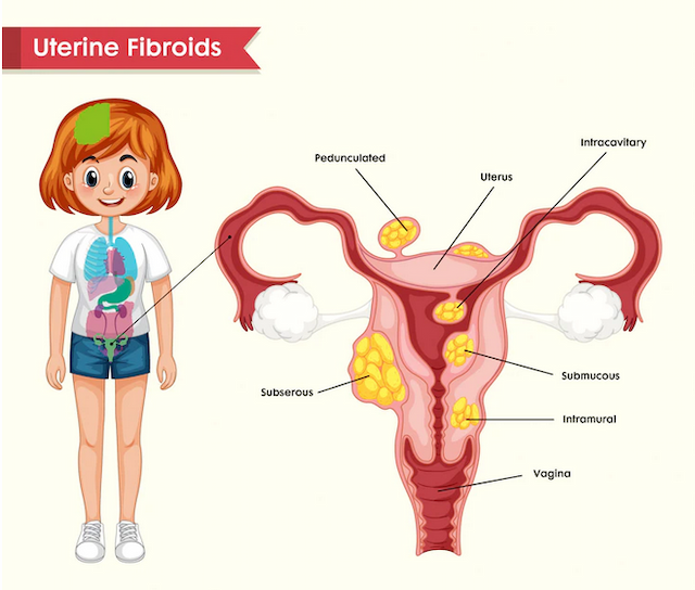 درمان فیبروم رحم