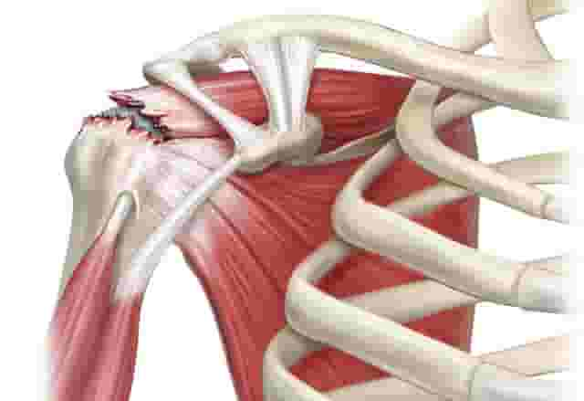 آسیب تاندونهای روتاتورکاف شانه