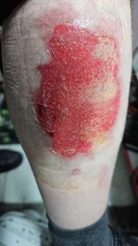 عکس تزریقات پانسمان زخم بستر فصد ویزیت در منزل تبریز