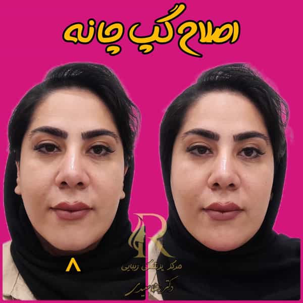 عکس بوتاکس و فیلر(ژل لب) کرمان دکتر رضا سعیدی در آبنوس کرمان