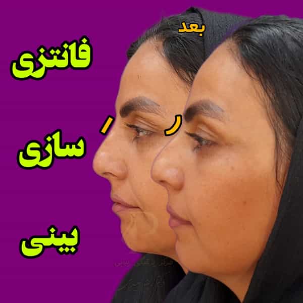 عکس بوتاکس و فیلر(ژل لب) کرمان دکتر رضا سعیدی در آبنوس کرمان