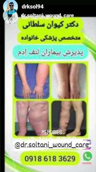 عکس زخم دیابتی لنف ادم لاغری و زیبایی دکتر کیوان سلطانی در کسری کرمانشاه