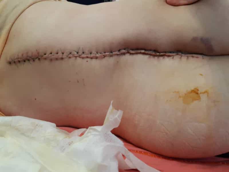 عکس مرکز ترمیم زخم بستر سوختگی پای دیابتیک تبریز نرس