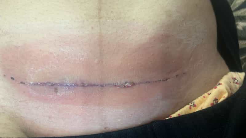 عکس مرکز ترمیم زخم بستر سوختگی پای دیابتیک تبریز نرس