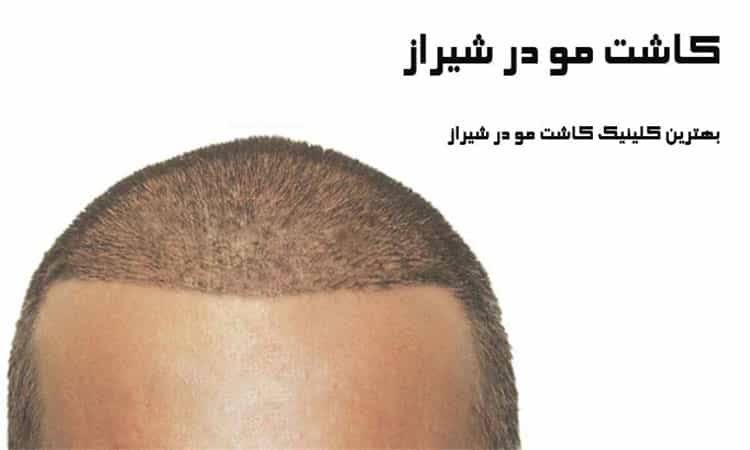 عکس مرکز کاشت مو ظرافت کاشت مو طبیعی ، ابرو و ریش در شیراز