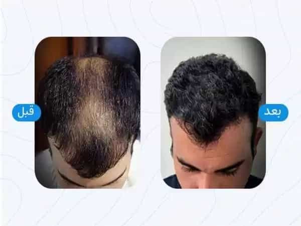 عکس مرکز کاشت مو ظرافت کاشت مو طبیعی ، ابرو و ریش در شیراز