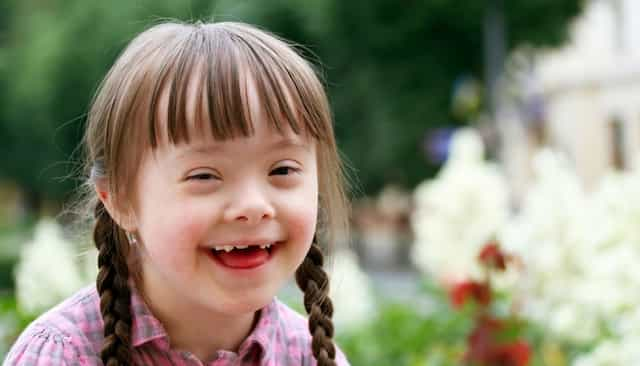 سندروم داون (Down syndrome)