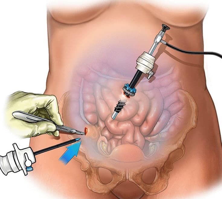لاپاروسکوپی  