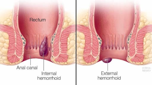 درمان بواسیر یا hemorrhoids