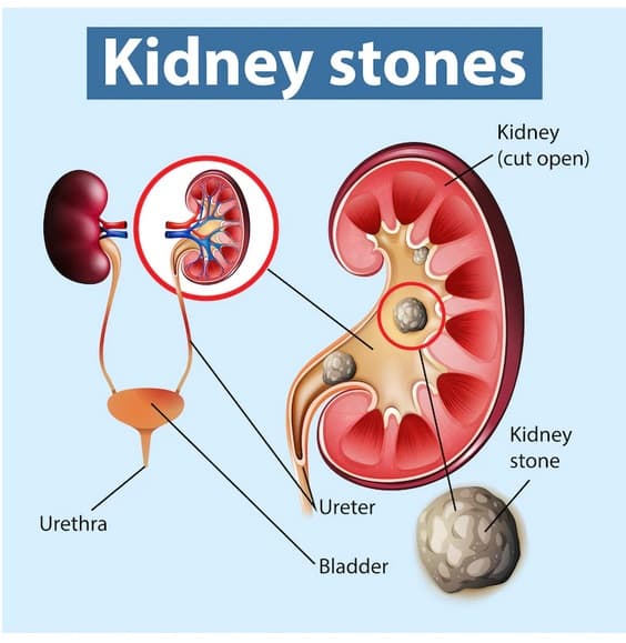 درمان سنگ کلیه