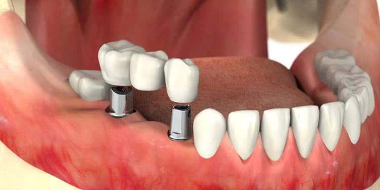 جراحی ایمپلنت دندان