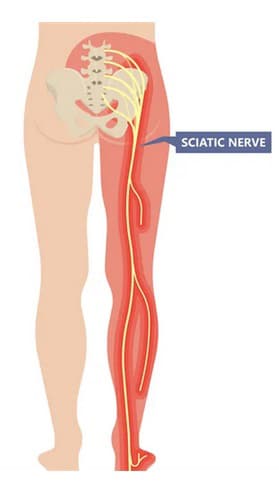 درمان سیاتیک