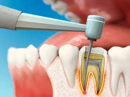 درمان ریشه دندان 