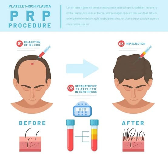 درمان ریزش مو با تزریق پی آر پی