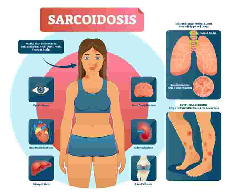 آیا سارکوئیدوز نوعی سرطان است؟